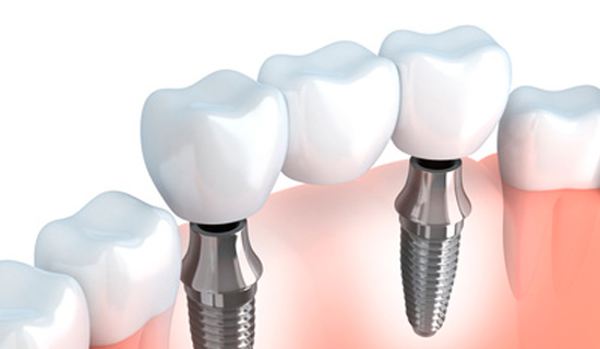 prótesis-dental